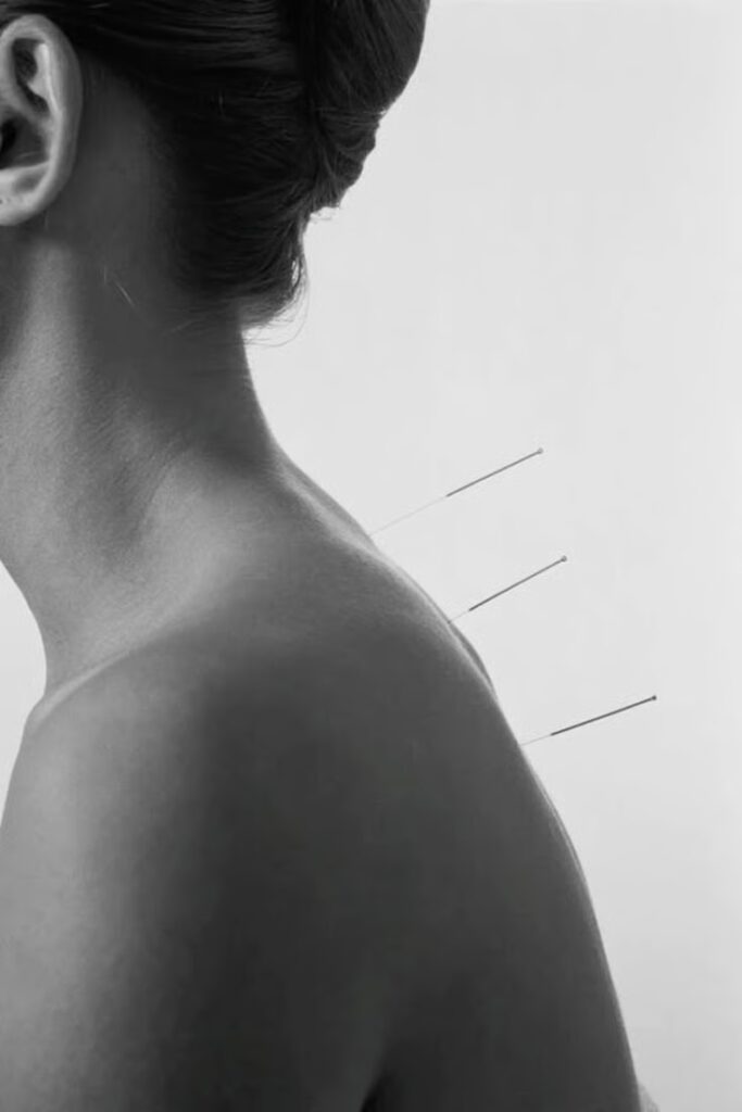 acupuntura